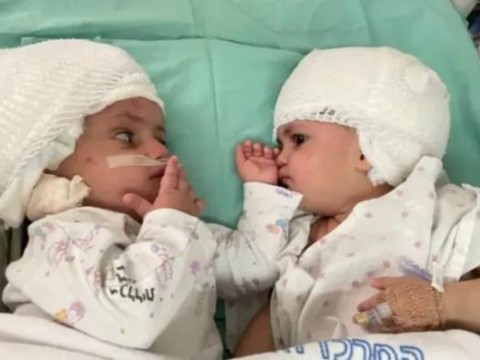 用VR反复练习高度复杂手术，以色列医生为头颅连体婴成功实现分离手术