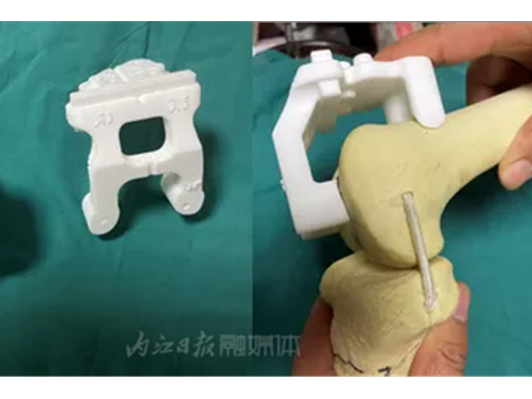 内江市中医医院用3D打印了一个膝关节救人