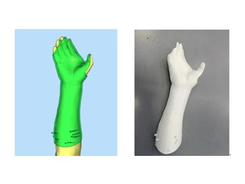 南科大医院：巧用“3D打印+肉毒素”治疗中风后痉挛性瘫痪