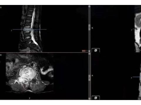 烟台山医院成功完成全脊柱肿瘤切除＋3D打印人工椎体置换术