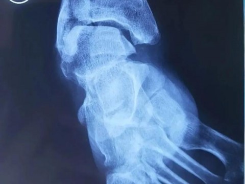 邯郸市第一医院3D打印技术指导马蹄内翻高弓足截骨矫形四关节融合术